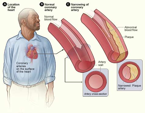 Coronary Artery Disease - Atherosclerosis